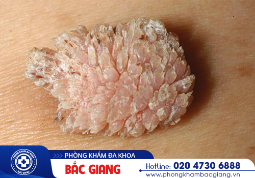 Ngứa bao quy đầu là bệnh gì Cách điều trị như thế nào?